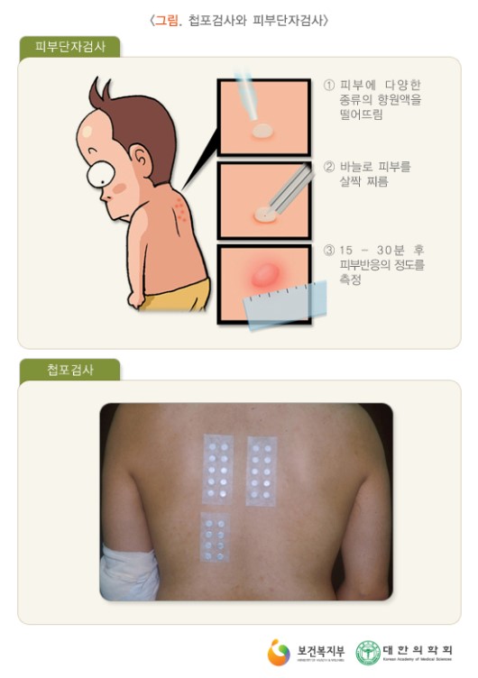 첩포검사와 피부단자검사