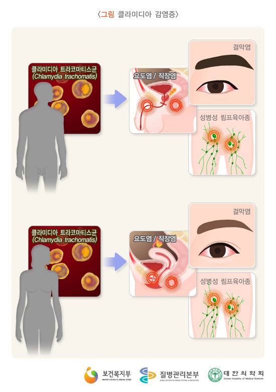 클라미디아 감염증. 동그란 주황색 클라미디아 트라코마티스균(Chlamydia trachomatis)에 감염된 환자의 증상 삽화.(아래 설명글 참조.)