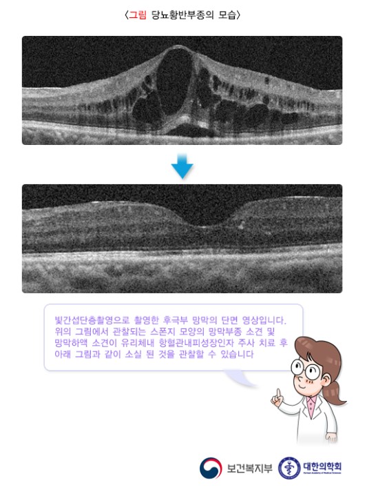 당뇨황반부종의 모습