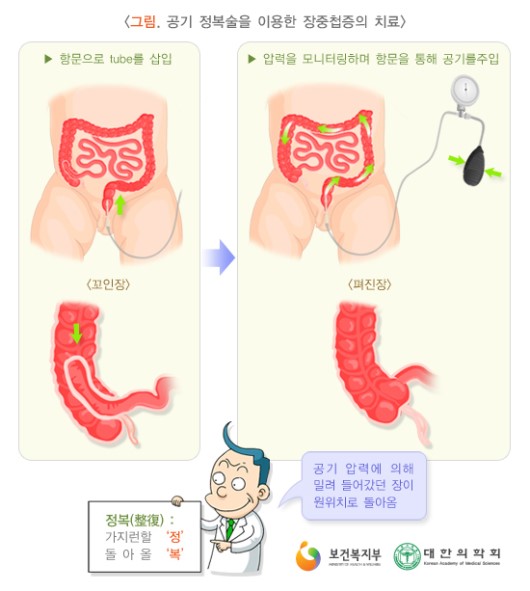 공기 정복술을 이용한 장중첩증의 치료