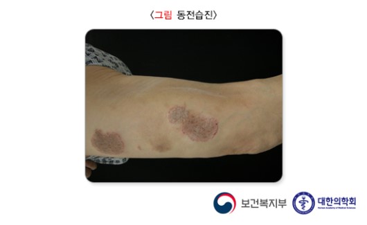 동전습진