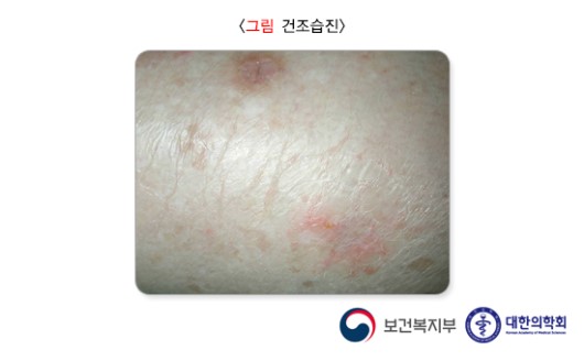 건조습진