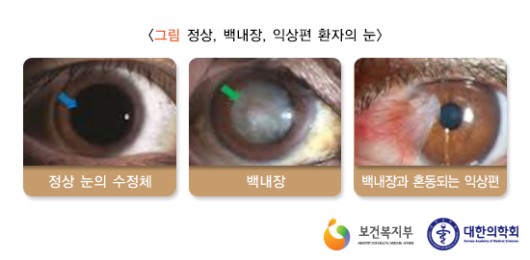 정상, 백내장, 익상편 환자의 눈