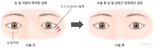 눈밑지방 제거 시술 전과 후
