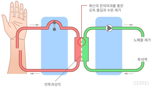혈액 투석의 원리