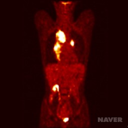 림프종 양전자방출 단층촬영