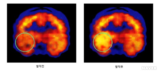 우측 측두엽 뇌전증 환자의 단일광자방출 단층촬영