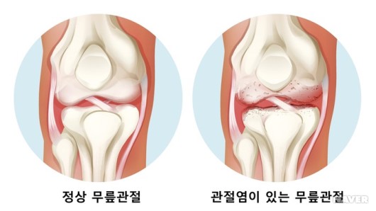 무릎 관절염