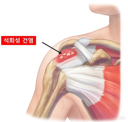 석회성건염 본문 이미지 1