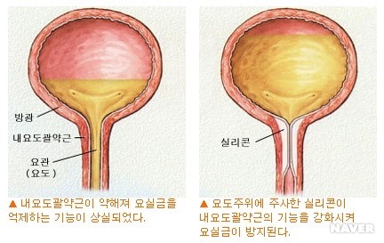 요실금 본문 이미지 2