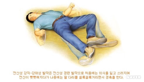 간질에 대하여 본문 이미지 1