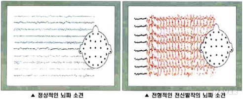 간질에 대하여 본문 이미지 2