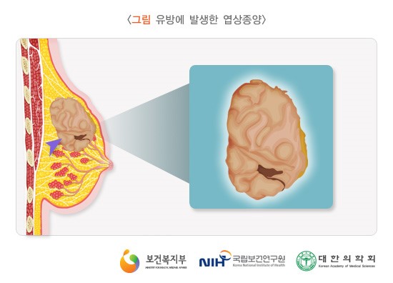 유방에 발생한 엽상종양