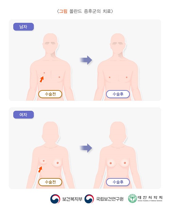폴란드 증후군의 치료