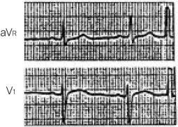 그림 5-11 : 1도 AV block
