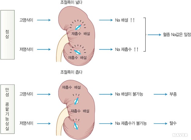 그림 8-4 : 조절폭이 좁은 만성 콩팥기능상실