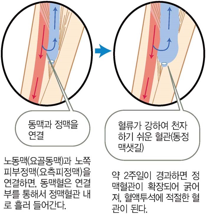 투석요법 - 그림 A : 동정맥샛길의 조성