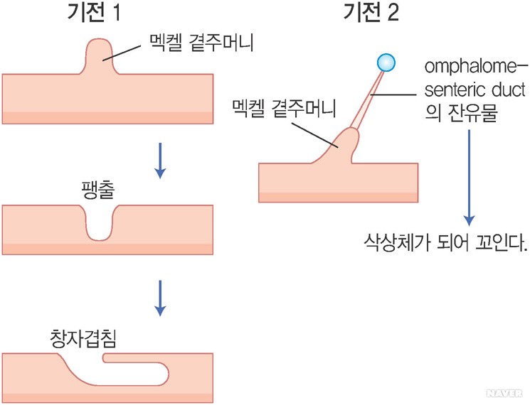 창자막힘증 - 그림 B : 멕켈 곁주머니와 창자막힘증