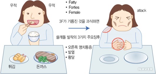 그림 11-7 : 쓸개돌 발작