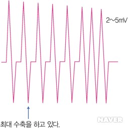 그림 6-37 : 신경성 MUP pattern