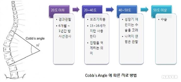 Cobb's Angle에 따른 치료 방법