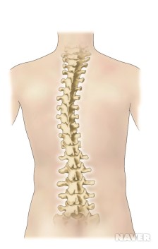 척추측만증
