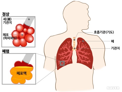 폐렴