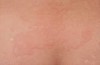 두드러기(Urticaria)