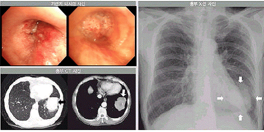 폐암의 기관지내시경검사, 흉부 전산화단층촬영(CT), 그리고 단순 X-선 촬영 소견