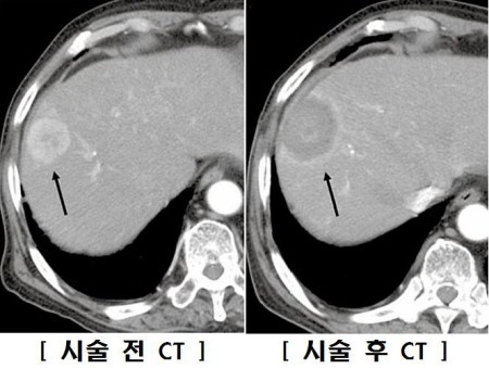 간암 - 고주파 열치료술 시술 전후의 간암 비교(CT 영상)