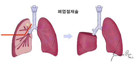 폐엽절제술