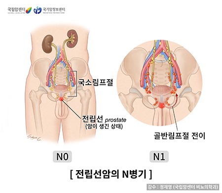 전립선암 - 전립선암병기-N병기