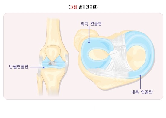 반월상 연골판 손상 - 반월연골판