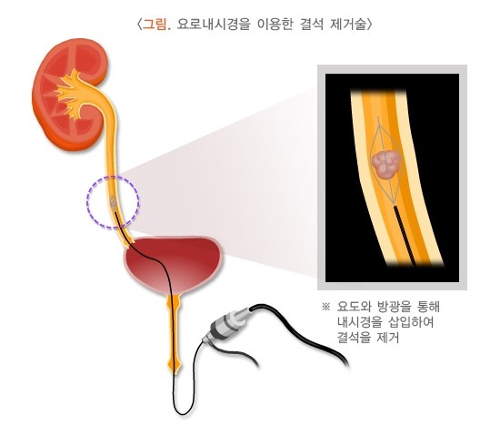신장결석 - 요로내시경을 이용한 결석 제거술